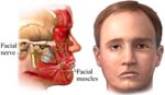 Неврит лицевого нерва